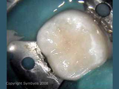 A 1-surface composite resin filling in a lower permanent molar (note rubber dam)