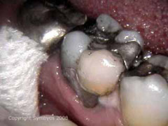 Lower molar tooth with failing restorations and recurrent decay needs to be crowned