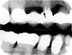 Failing pier abutment from caries around core buildup in overloaded fixed bridge (denture)