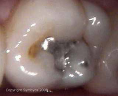 Old silver (dental amalgam) filling contains mercury but is a low priority for replacement