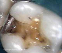 Recurrent caries (secondary tooth decay) under a cracked silver filling