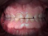 Bruxism / Teeth grinding or jaw clenching