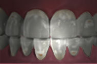 Tooth enamel demineralization