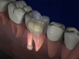 Failing root canal