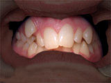 Malocclusion (misaligned teeth)