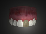 Necrotic teeth