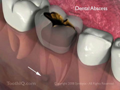 An acute apical abscess resulted from deep dental caries or decay in this molar tooth.