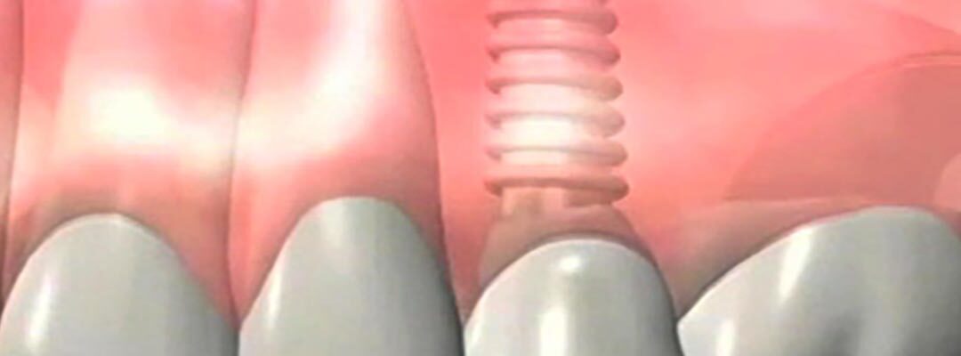 dental-implant-header