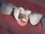 Tooth Damage Symptoms