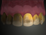 Tooth Discoloration Symptoms