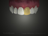 Tooth Symptoms (Miscellaneous)
