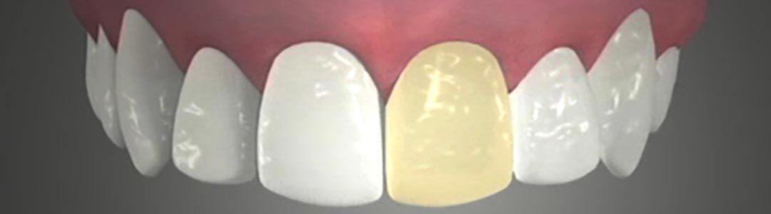symptom-tooth-header-1400×300