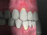 Preventing receded gums