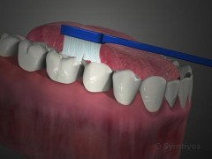 Preventing Dental Problems