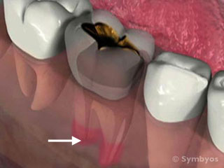 acute-apical-abscess-dental-pain-tooth-infection-320