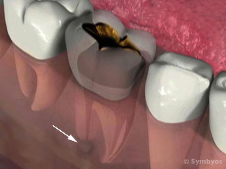 acute-apical-abscess-dental-pain-tooth-infection