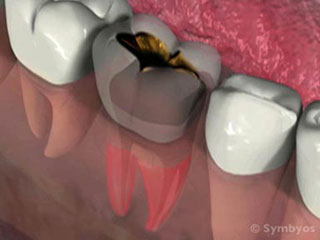 acute-apical-periodontitis-toothiq-320