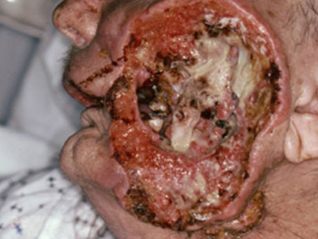 Advanced oral cancer: basal cell carcinoma of the head and neck