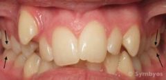 Angle Class I crowded malocclusion shows palatal constriction.