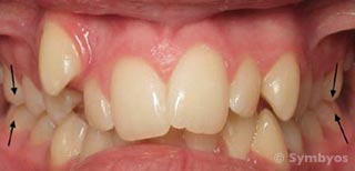angle-classi-crowded-crooked-teeth-malocclusion-maxillary-dental-arch-constriction
