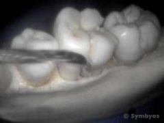 Atraumatic tooth extraction involves use of periotome to release gums from jawbone.