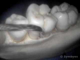 atraumatic-tooth-extraction-procedure-periotome-gums-jawbone-320