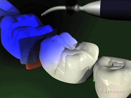 blue-light-photopolymer-cure-dental-composite-resin-filling-460×345