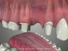 bridge-preparation-tooth-reduction-options-missing-teeth