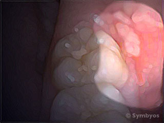 Canker sores (aphthous ulcers) are a type of mucosal lesion seen in Behcet Syndrome.