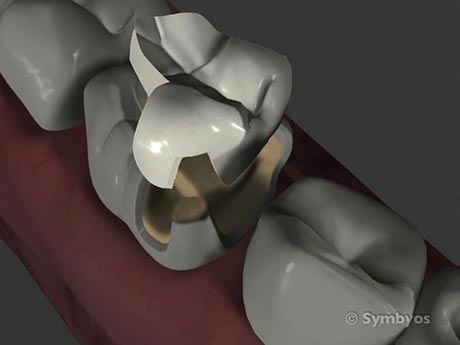 A ceramic inlay to treat a decayed tooth through minimally invasive dentistry.