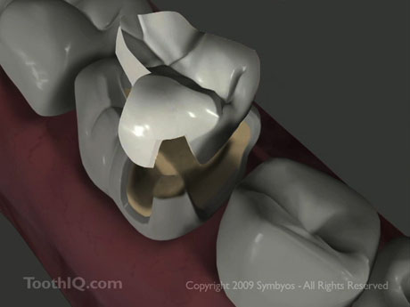 ceramic-inlay-onlay-decayed-tooth-minimally-invasive-dentistry