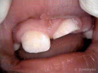 A young boy sustained a large front tooth chip while playing hockey with no athletic mouth guard.