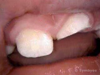 chipped-tooth-anterior-sports-injury-large-320