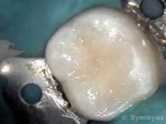 A 1-surface composite resin filling in a lower permanent molar (note rubber dam).