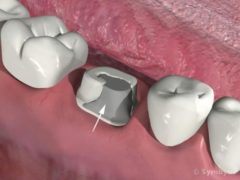 Silver amalgam dental filling material used to base a crown preparation to full contour is not the same thing as a core buildup with pins or posts.