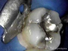 Cracked lower molar tooth with decay and fractures extending from silver filling.