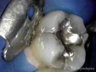 cracked-molar-tooth-enamel-fractures-silver-filling-recurrent-caries-320