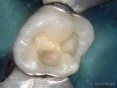 Decay under failing molar tooth sealant.