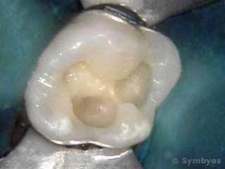 decay-failing-molar-tooth-sealant-pulp-exposure-root-canal-320