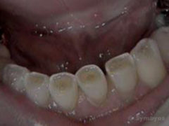 Severe tooth wear of the lower front teeth (attrition).