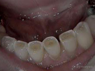 dental-attrition-tooth-wear-bruxism-320