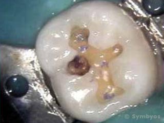 Dental caries (tooth decay, or cavities) has infected this lower molar tooth.