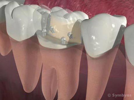 dental-core-buildup-molar-tooth-shown-transparent-visualize-minikin-pins-460