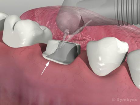 dental-crown-preparation-margin-molar-tooth-460