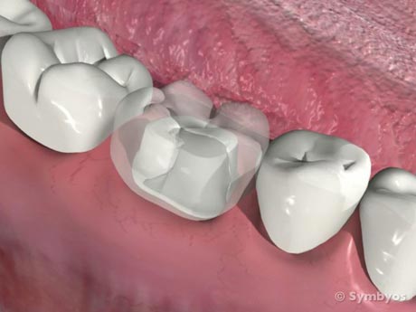 dental-crown-see-through-preparation-visible-molar-tooth
