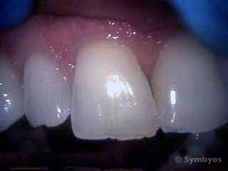 dental-damage-chipped-teeth-factitious-habits-320