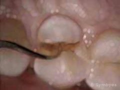 Virgin (unfilled) tooth fractured to bone level by a popcorn kernel.