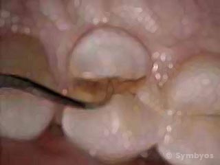 dental-deep-fracture-bicuspid-tooth-popcorn-kernel-320