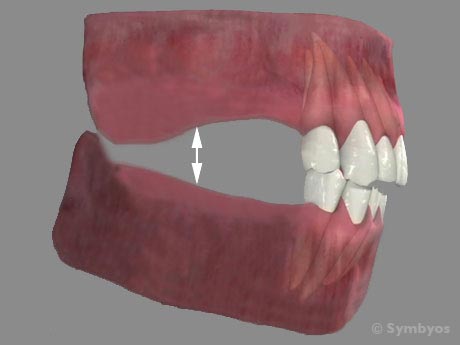 dental-diagnosis-image-bite-collapse-loss-vertical-dimension-occlusion-interocclusal-space