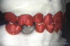 Diagnostic equilibration is first performed on casts of the teeth in dental malocclusion.